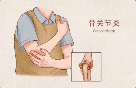 生活中怎樣預(yù)防骨關(guān)節(jié)炎？