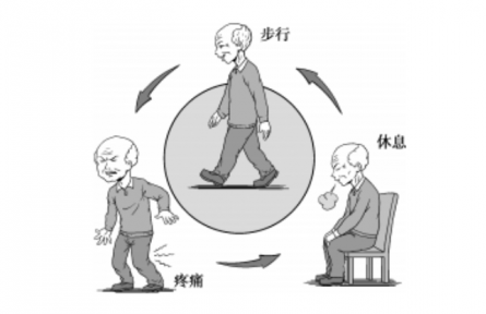 健康問(wèn)答|什么是間歇性跛行？