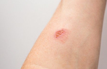 辟謠|燙傷后，可用白糖急救？