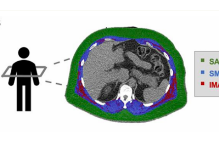 骨骼肌肌間脂肪多，心血管病風(fēng)險(xiǎn)高